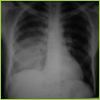 pleural_jpg2
