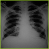 pleural_jpg3