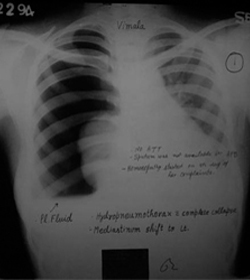 Hydro Pneumothorax